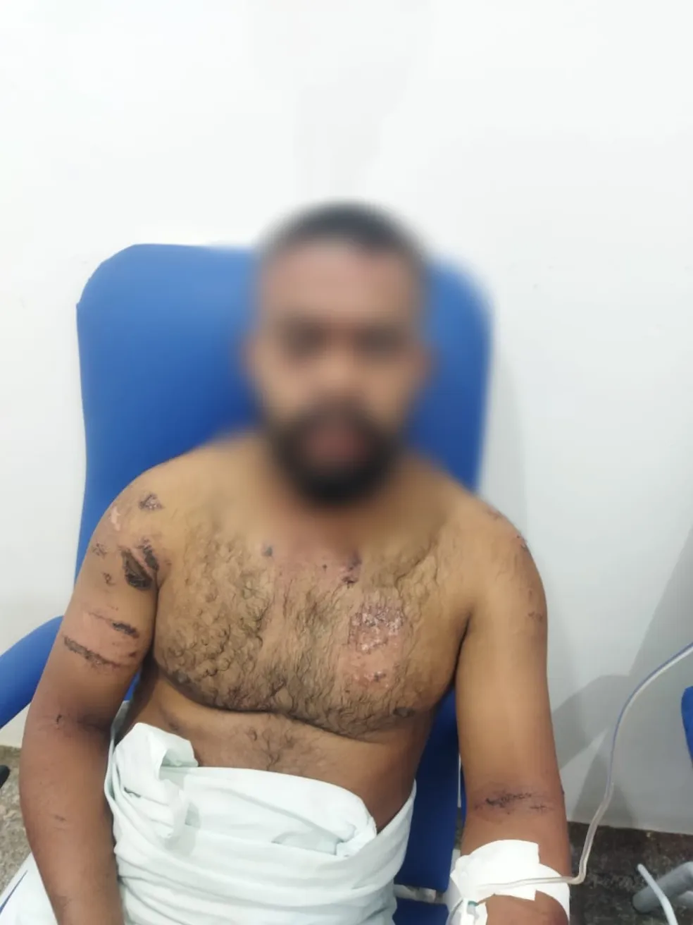 Suspeita de jogar ácido no rosto do companheiro no MA é presa no estado do Pará